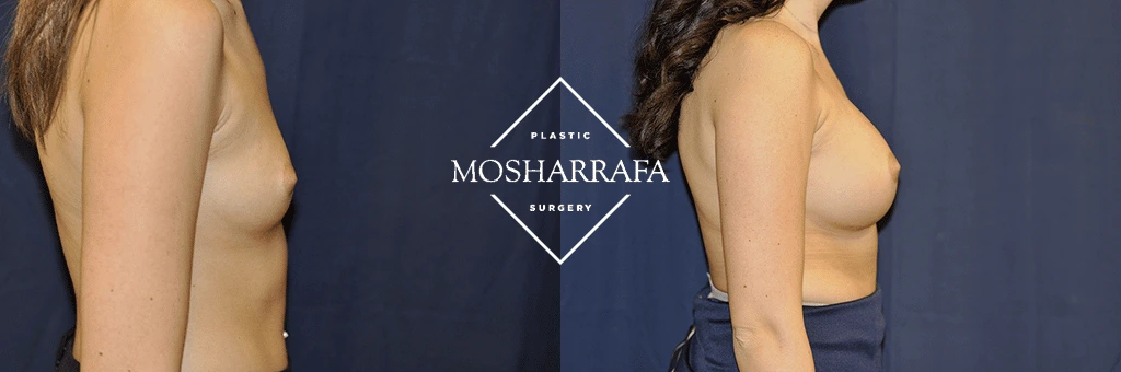 Breast augmentation before and after, side profile comparison