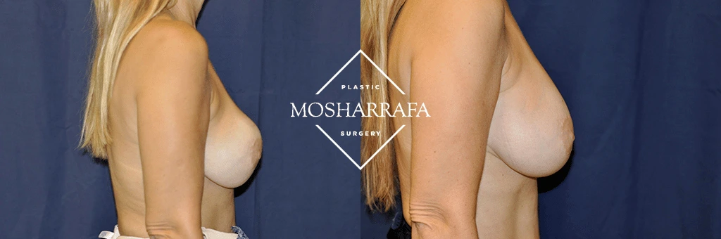 Before and after side profile views of breast augmentation results from Plastic Mosharrafa Surgery