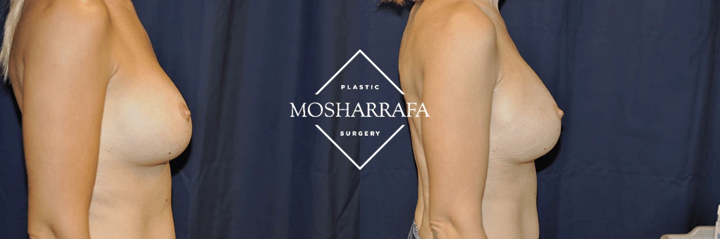 Before and after side profile views of breast augmentation results from Plastic Mosharrafa Surgery