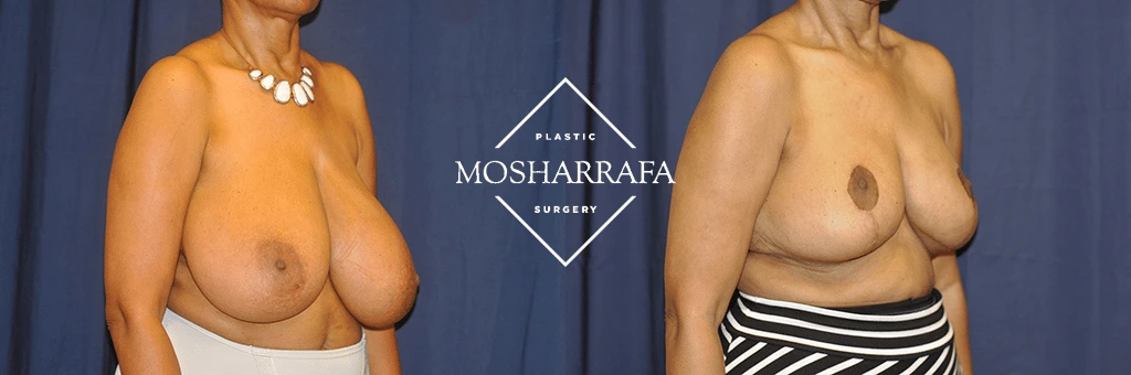 Before and after breast surgery results, side view