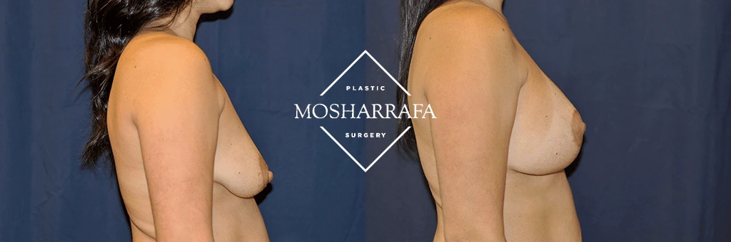 Before and after breast augmentation results, profile view