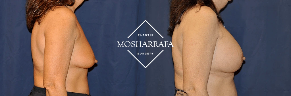 Before and after side view comparison of breast augmentation surgery results