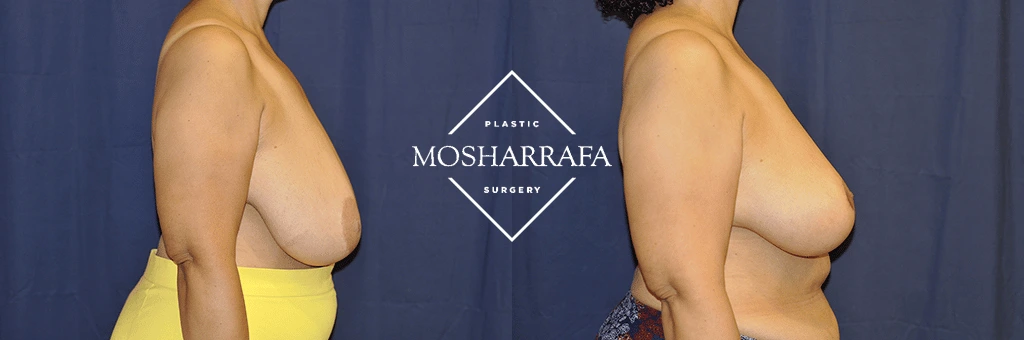 Before and after breast surgery comparison, side profile view
