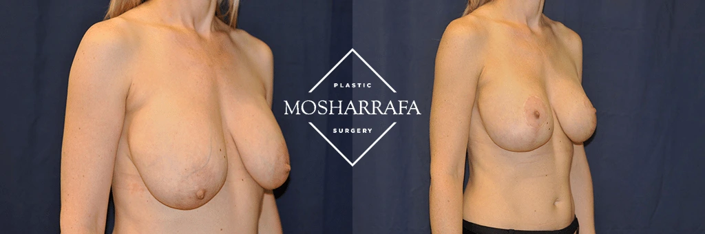 Before and after breast surgery results shown side view
