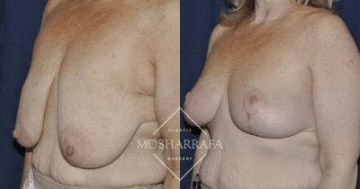 Before and after breast lift, side view