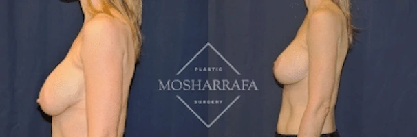 Breast augmentation before and after, side profile comparison
