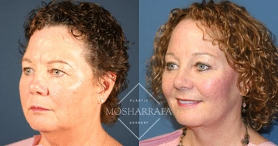 Before and after three-quarter facial views displaying skin refinement and contour enhancement