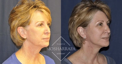 Before and after profile views of a patient showing facial rejuvenation results