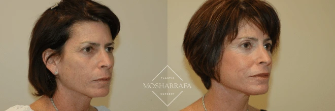 Before and after side profile comparison of a woman's face showing results of facial sculpting