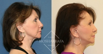 Before and after side profile comparison of a woman's face showing facial rejuvenation results