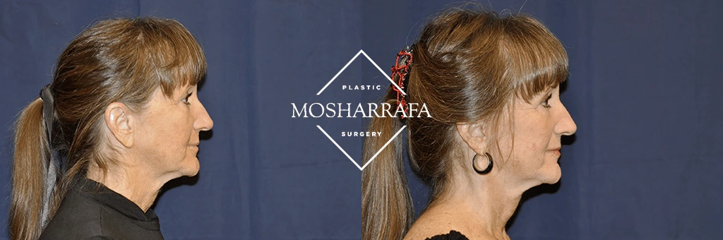 Before and after side profile of a woman with pulled-back hair showing facial contouring results