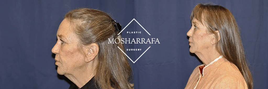 Before and after profile views of patient demonstrating facial enhancement results at Mosharrafa Surgery