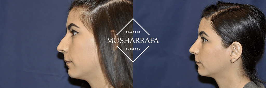 Before and after profile view of female patient showing facial profile enhancement