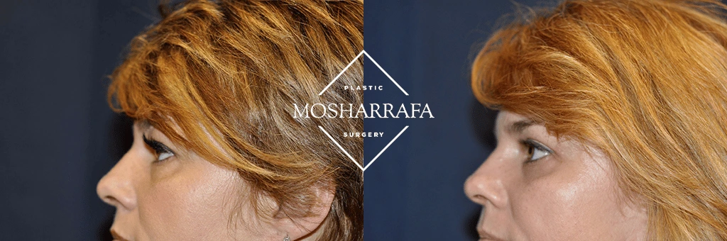 Before and after side profile showing improved facial projection and definition