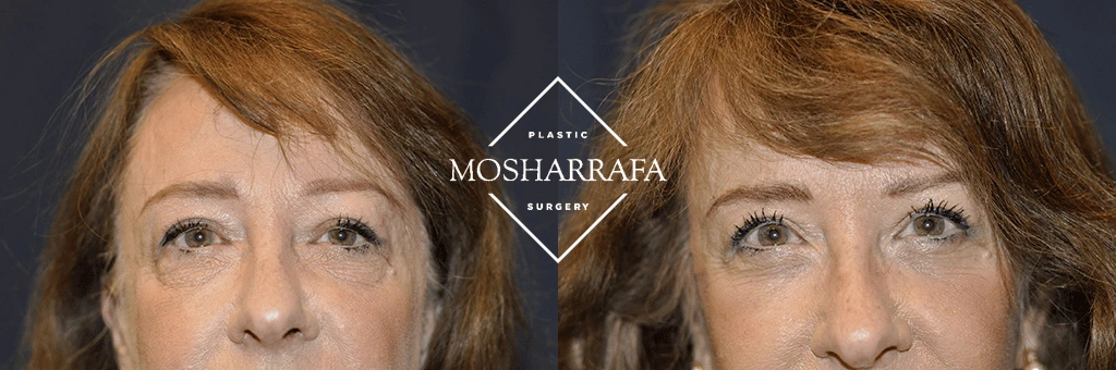 Before and after facial rejuvenation, frontal view showing improved eye area and skin texture