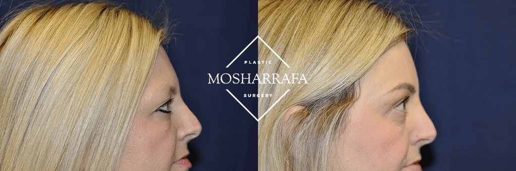 Before and after profile views showing facial contouring results
