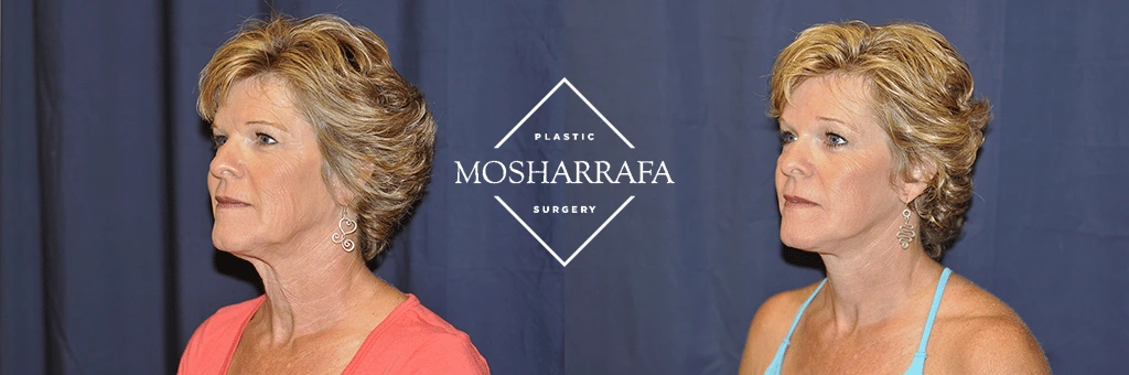 Before and after profile view of woman's face showing facial rejuvenation results