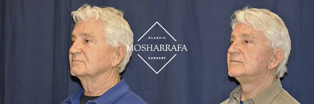 Male patient side profile views before and after facelift procedure