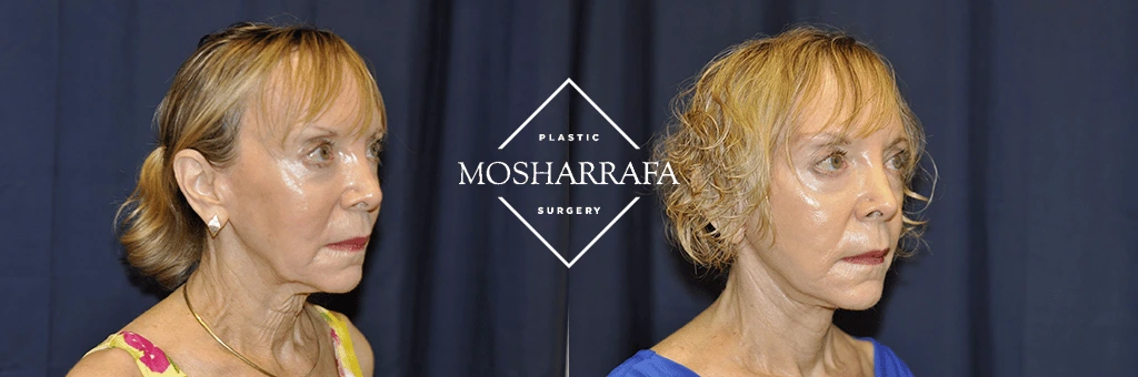 Female patient three-quarter profile views before and after facelift procedure