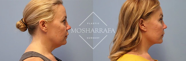 Before and after profile views of facelift results showing improved neck appearance and facial tightening