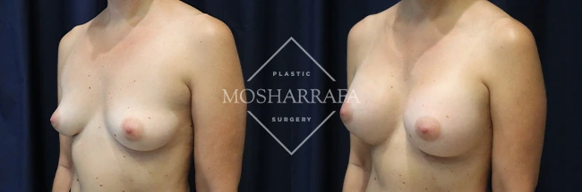 Before and after front view comparison of breast augmentation results