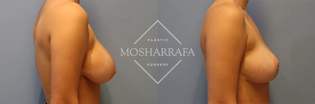 Side profile before and after surgical results showing aesthetic breast enhancement