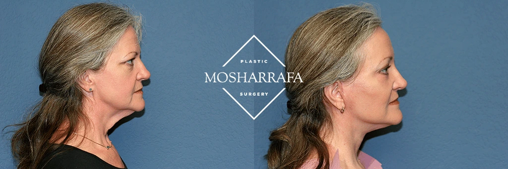 Before and after profile views showing left side of a woman's face and neck contour