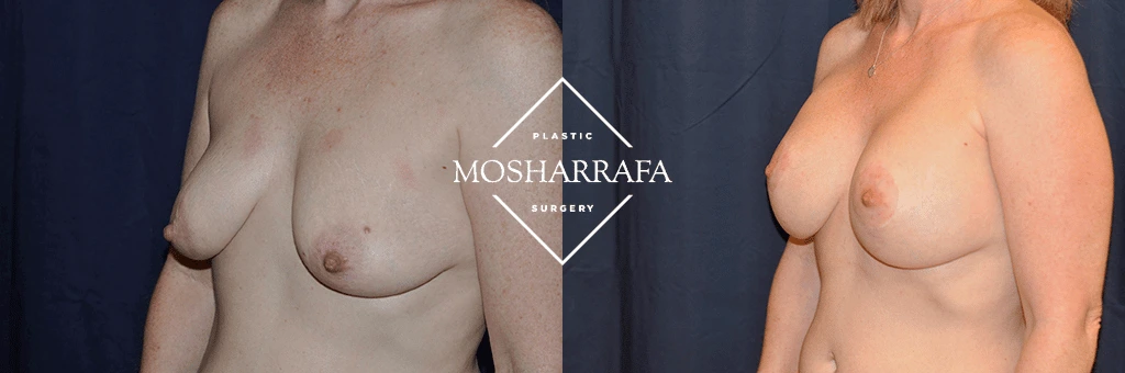 Before and after breast augmentation results, frontal view