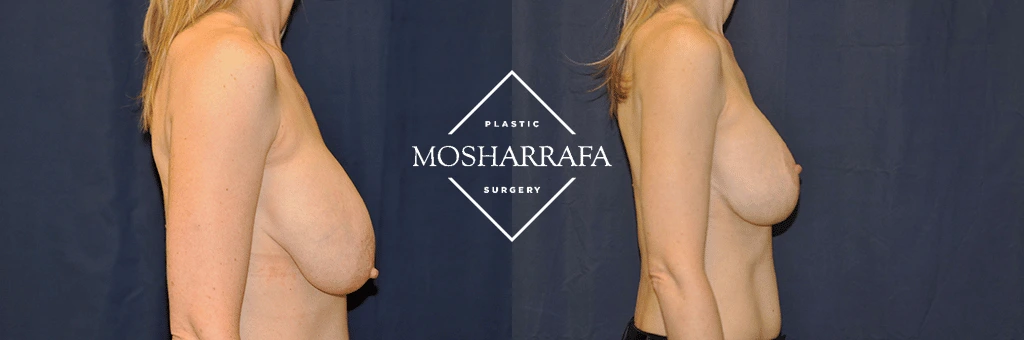 Before and after breast surgery results shown side view