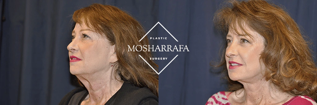Three-quarter profile views of a patient showing before and after facelift and skin tightening outcomes