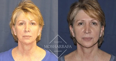 Before and after frontal views of a patient showing facial contouring results