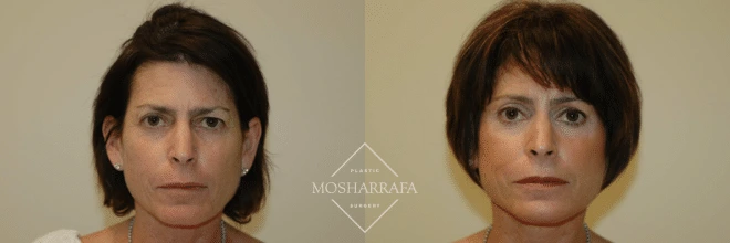 Before and after front-facing comparison of a woman's face showing results of facial procedures