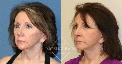 Before and after front-facing view of a woman's face showing facial enhancement results