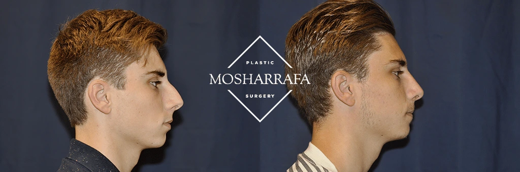 Before and after left profile view of male patient's face and neck