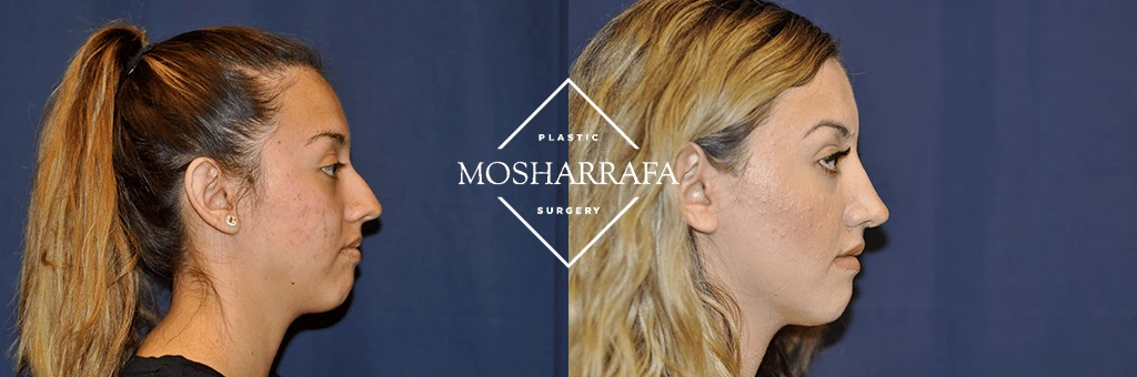 Before and after three-quarter profile facial photos from case 263
