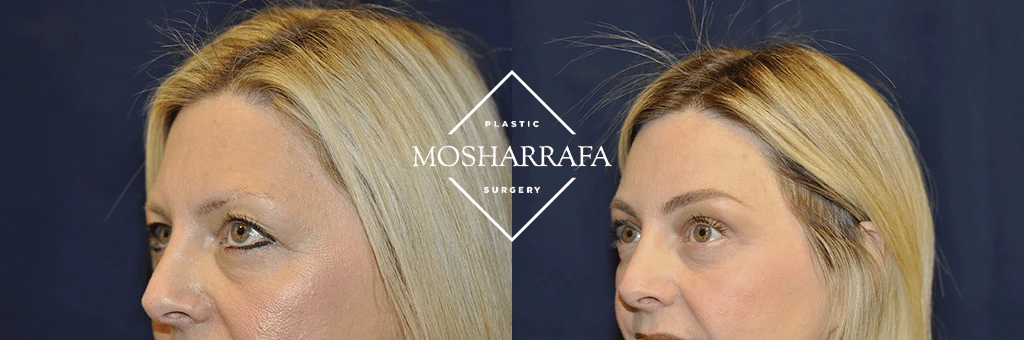 Before and after profile views showing refined facial structure