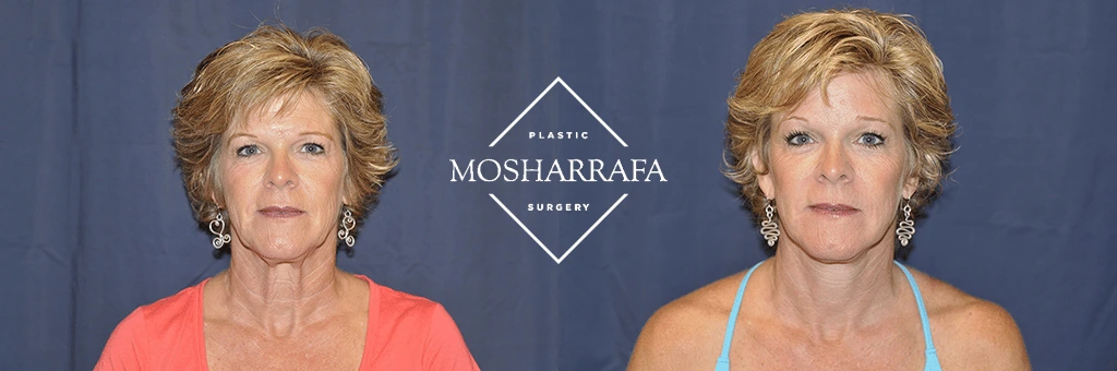 Before and after frontal view of woman's face showing facial rejuvenation results
