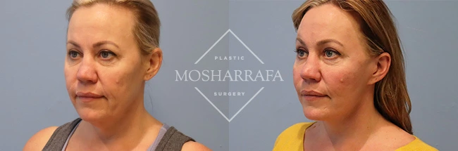 Before and after facial comparison showing front-facing views of a woman's face