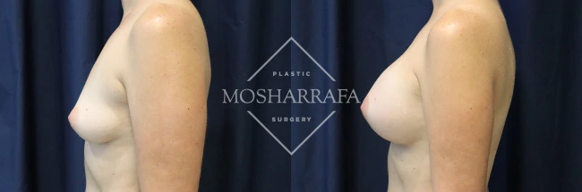 Before and after side profile comparison of breast augmentation results