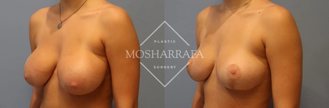 Side profile before and after surgical results showing aesthetic breast enhancement