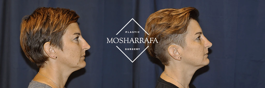 Before and after profile facial photos showing results of cosmetic procedure