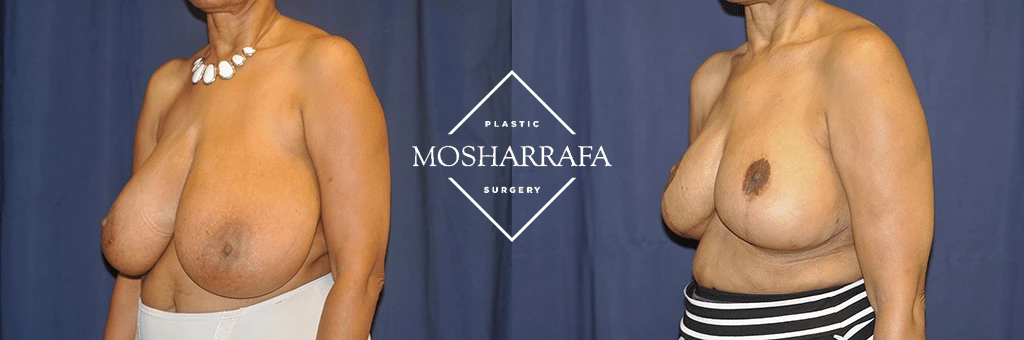 Before and after breast surgery results, side view