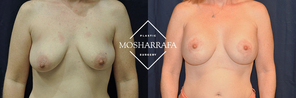 Before and after breast augmentation results, frontal view