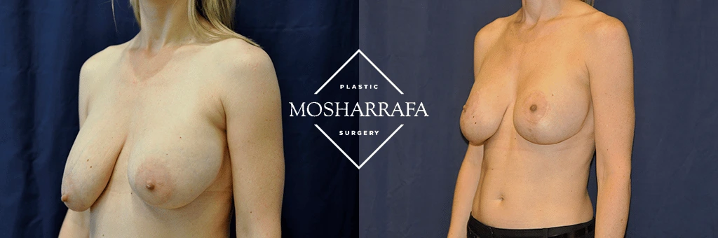 Before and after breast surgery results shown side view
