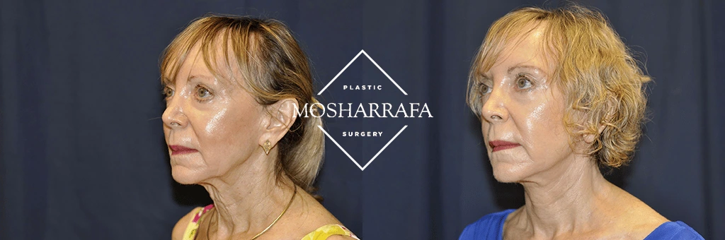 Before and after three-quarter views of facelift results showing enhanced jawline definition and reduced sagging