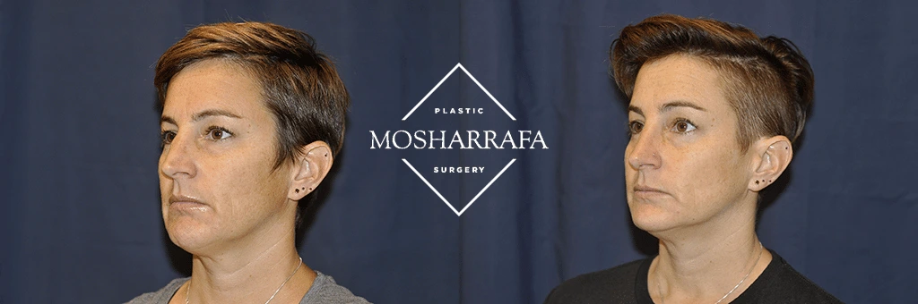 Before and after profile facial photos showing results of cosmetic procedure