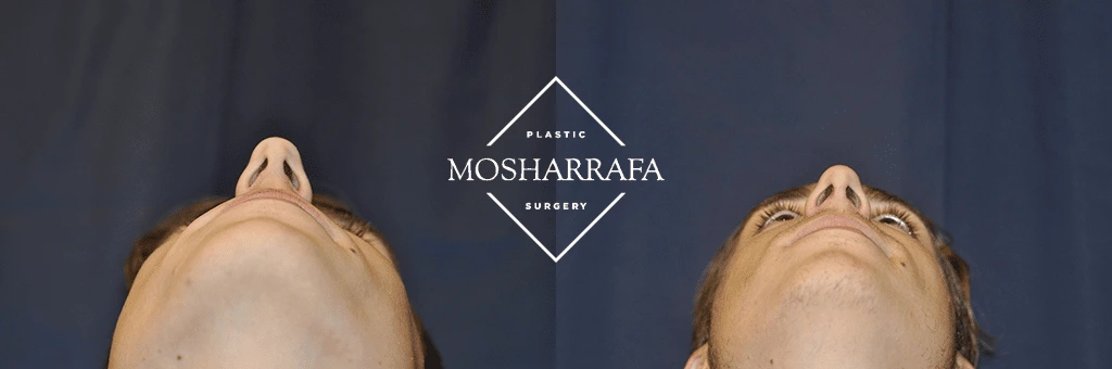 Before and after overhead view of male patient's head and neck