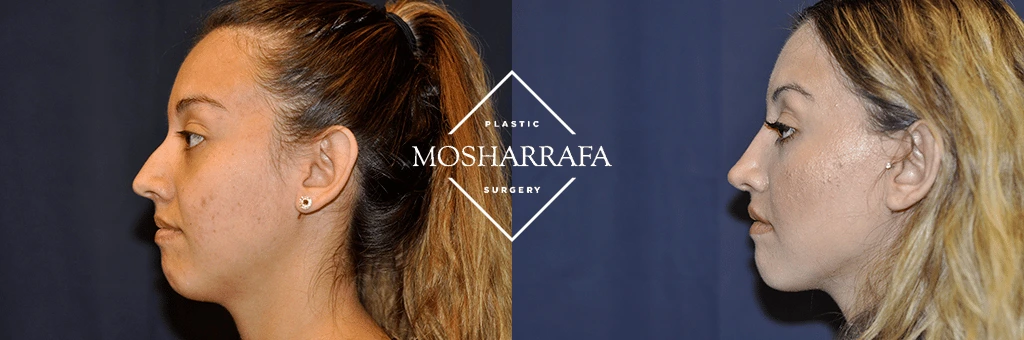 Before and after profile comparison showing facial contouring results