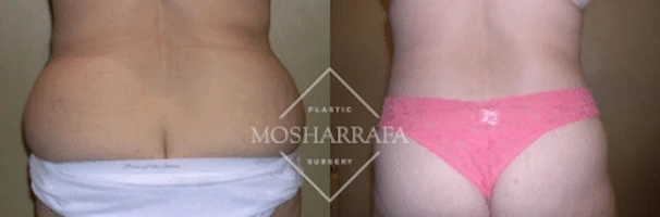 Before and after back and buttock body lift results