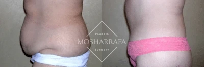 Before and after body lift results showing abdominal contouring and skin tightening